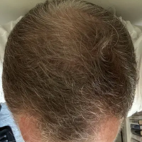 After Treatment