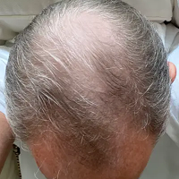 Before Treatment