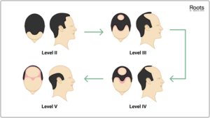 Receding Hairline vs. Maturing Hairline